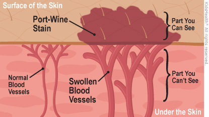 Port-Wine Stains (for Parents) - Nemours KidsHealth