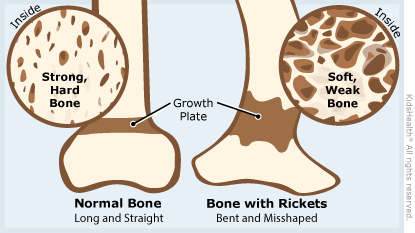 rickets in babies