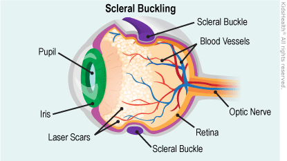 ROP scleral buckle illustration