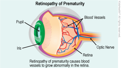 retinopathy of prematurity laser
