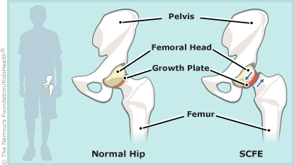 Slipped Capital Femoral Epiphysis (SCFE) (for Teens) - Hackensack Meridian  Health