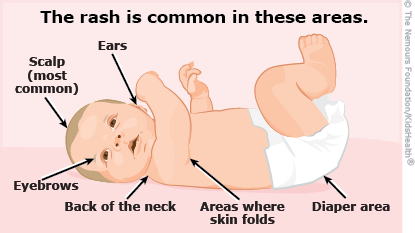 Cradle Cap (Seborrheic Dermatitis) in Infants (for Parents) - Nemours  KidsHealth
