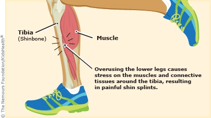 What are shin splints