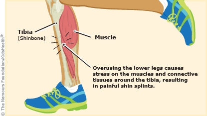 Shin Splints for Parents Humana Louisiana