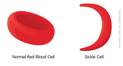 sickle cell symptoms and complications