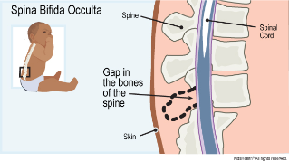 spina bifida in adults