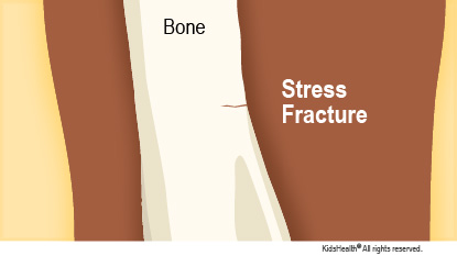 Stress Fractures (for Parents) - Nemours KidsHealth