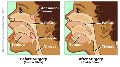 adenoidectomy before and after