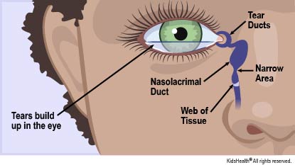 clogged lacrimal duct