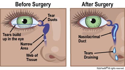 Surgery For Tear Duct Blockage For Parents Nemours Kidshealth