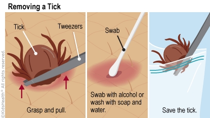 Tick Removal: A Step-by-Step Guide (for Parents) - Nemours KidsHealth