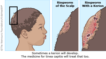 Are Scalp Ringworms Real? – Hana Story