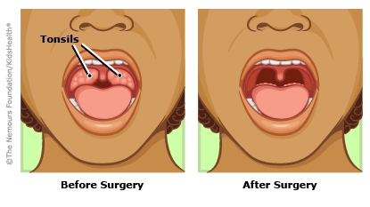 tonsillectomy tonsils kidshealth surgery tonsil pada amandel operasi prosedur
