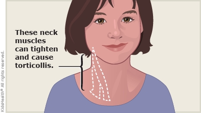 How to Relax Neck Muscles When They're Tight