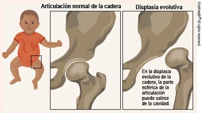 Displasia evolutiva de cadera (para Padres) - Nemours KidsHealth