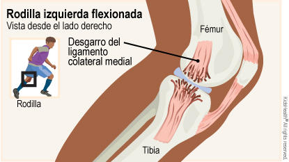 Lesiones del ligamento colateral medial (para Padres) - Nemours KidsHealth