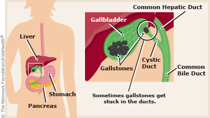 Cholelithiasis Gallstone