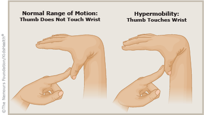 Some orthopedic features of JHS/EDS-HTA) Active joint hypermobility -  Download Scientific Diagram