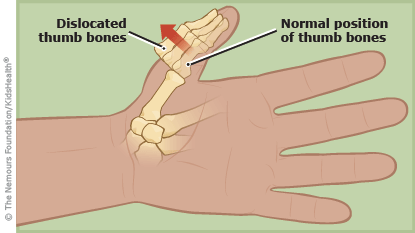 A to Z: Dislocation, Thumb (for Parents) - Nemours