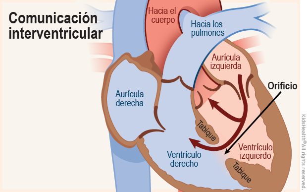 Se muestra el corte transversal del corazón con un defecto del tabique ventricular donde parte de la sangre fluye normalmente de la aurícula izquierda al ventrículo izquierdo y luego se dirige hacia la aorta.  Pero el orificio que hay en el tabique, también permite que la sangre fluya directamente desde la ventrículo izquierdo y llegue al ventrículo derecho.