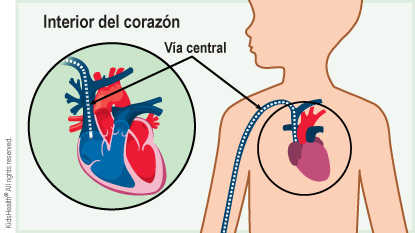 Se muestra una vía central que entra en el corazón a través de una vena en el brazo derecho de un niño.