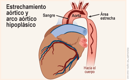 Se muestra un corazón con un estrechamiento aórtico y el arco aórtico hipoplásico; que es cuando se desarrolla fuera del corazón un área estrecha en la aorta que reduce o bloquea el flujo de sangre al cuerpo.