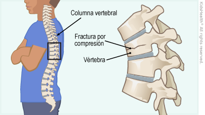 Fractura vertebral por compresión (para Padres) - Nemours KidsHealth