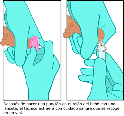 Después de hacer una punción en el talón del bebé con una lanceta, el técnico extraerá con cuidado sangre que se recoge en un vial.