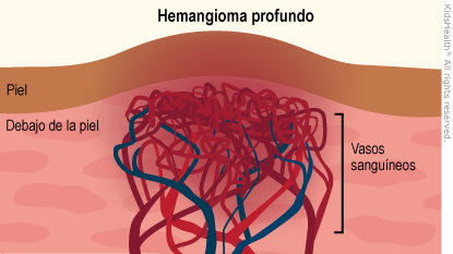Los hemangiomas profundos crecen debajo de la piel, producen un bulto, y a menudo tienen un color azulado. Los hemangiomas profundos también se denominan hemangiomas subcutáneos ("debajo de la piel").
