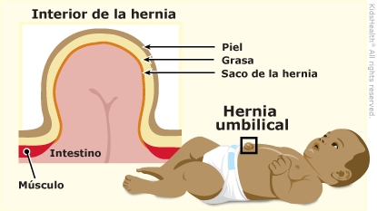 Hernias umbilicales (para Padres) - Nemours KidsHealth