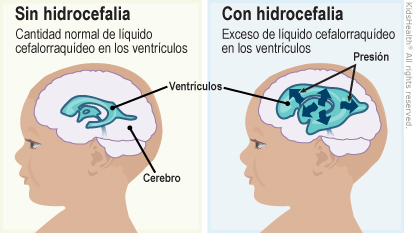 Hidrocefalia (para Padres) - Nemours KidsHealth