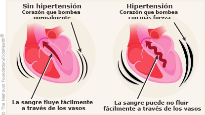 Hipertensión arterial (tensión arterial alta) - Nemours