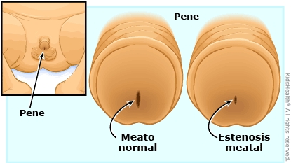 Estenosis del meato urinario (para Padres) - Nemours KidsHealth