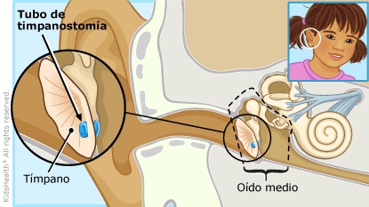 Operación de colocación de tubos de ventilación en el oído (para Padres) -  Nemours KidsHealth