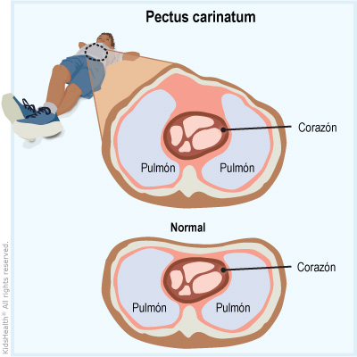 Trastorno de la pared torácica: Pectus carinatum (para Padres) - Nemours  KidsHealth