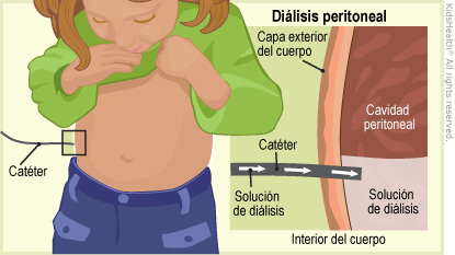 Diálisis peritoneal (para Padres) - Nemours KidsHealth