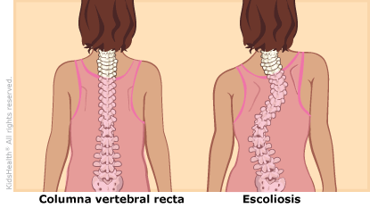Dolor de espalda por escoliosis: Causas y tratamiento