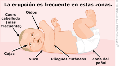Costra láctea (dermatitis seborreica) en los bebés (para Padres