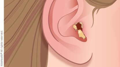 Cómo limpiar los oídos de un niño sin bastoncillos