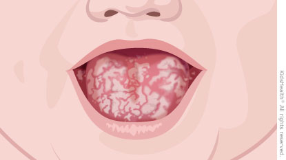 https://kidshealth.org/content/dam/patientinstructions/es/images/thrush_a_enIL.jpg?utm_source=chatgpt.com