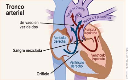 Se muestra un corte transversal del corazón con tronco arterial común: un defecto congénito en el que solo un vaso sanguíneo sale del corazón (en lugar de dos: la aorta y la arteria pulmonar) y un orificio permite que la sangre mezclada salga del corazón.