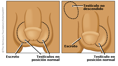 A to Z: Undescended Testicle (for Parents) - Children's Health Network