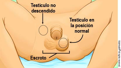 Se muestra un testículo no descendido y el otro testículo en la posición normal en el escroto.